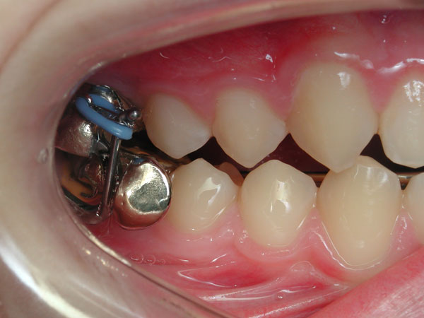 Clancy ondersteboven programma Orthodontie voor kinderen - apparatuur / beugelgalerij - Churchill  Orthodontics bvba